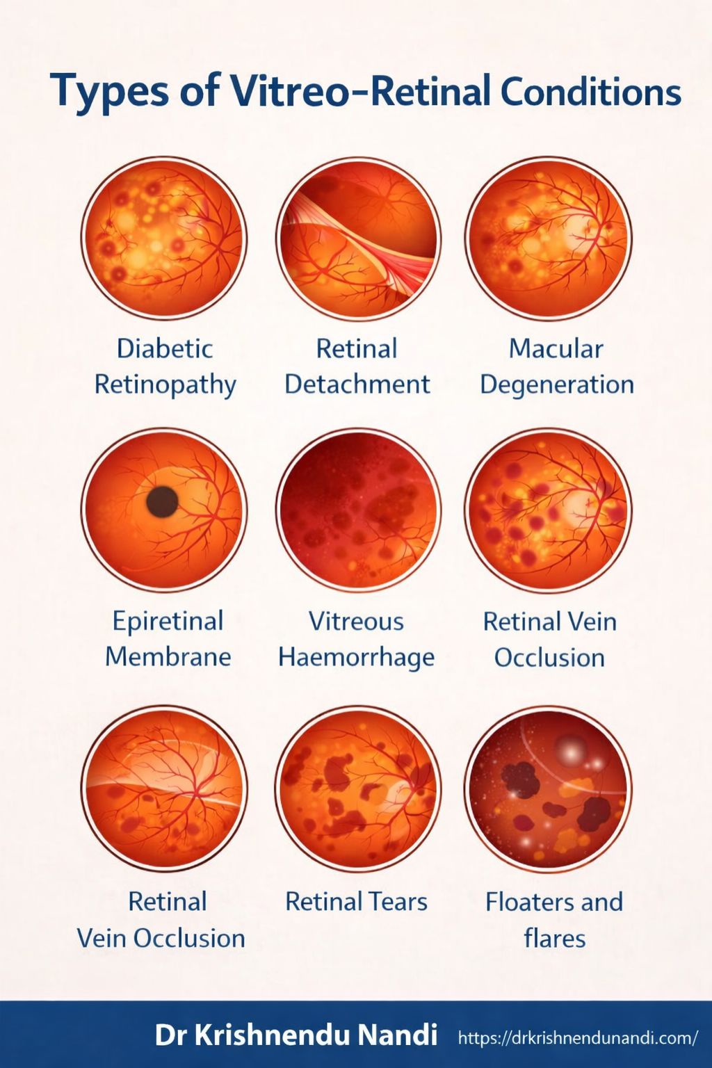 Types of Vitreo-Retinal Conditions